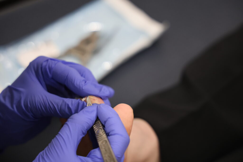 Podiatrist carefully removing hardened skin during clinical callus treatment