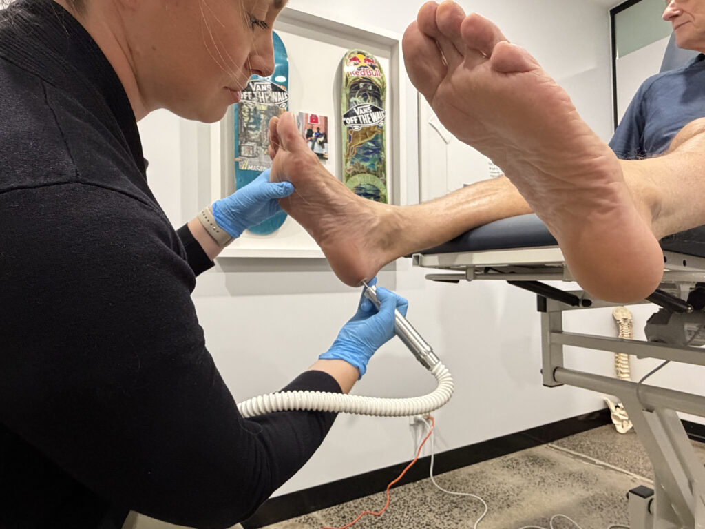 Professional hard-skin removal and heel fissure treatment by a podiatrist in Melbourne CBD.